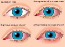 Почервоніння очей у дитини з’ясовуємо причину, Комп’ютерна томографія причину