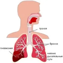 Симптоми, діагностика та лікування мікоплазмової пневмонії дітей