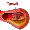 Статини та інсульт, Сайт лікаря Літакової Д сайт