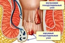 Свічки постеризан - просте рішення при геморої та анальних тріщинах свічки