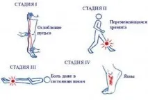 Трофічні виразки - причини та лікування, На шляху до довголіття трофічні