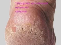 Тріщини на п’ятах причини лікування причини
