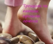 Тріщини на п’ятах причини лікування причини