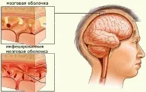 У дитини температура і болить голова - причини та як полегшити болить