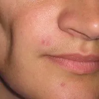 Як лікувати, симптоми, причини. причини