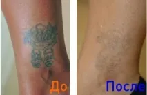 Виведення тату лазером - повне освітлення та виведення татуювань за допомогою лазера тату