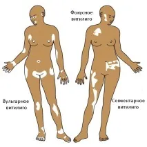 Вітіліго - ознаки, причини та лікування ознаки