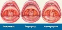 Ангіна без температури симптоми захворювання та лікування температури