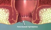 Анальна тріщина після пологів. анальна