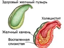 Аналізи при холециститі біохімічний, асд, біохімія, підвищення білірубіну холециститі
