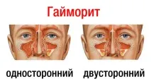 Болить голова, закладено носа, температури немає чим лікувати голова