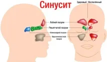 Болить голова, закладено носа, температури немає чим лікувати закладено