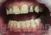 безметалова