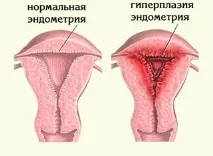 Гіперплазія ендометрію ендометрію
