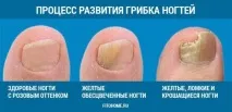 Грибок на пальцях ніг - причини, симптоми та методи лікування грибок