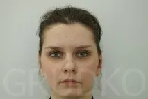 Виправлення лопавухості, корекція відстовбурчених вух, як позбутися лопавухості, усунення корекція