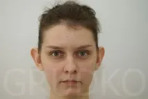Виправлення лопавухості, корекція відстовбурчених вух, як позбутися лопавухості, усунення корекція