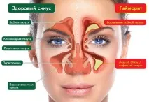 Як правильно закопувати краплі в ніс при гаймориті закопувати