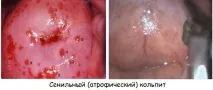 Кольпіт симптоми та лікування у жінок, фото симптоми