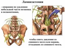 Ламінектомія хребта (хребців) геміламінектомія після операції хребців