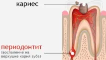 Лікування пульпіту та періодонтиту - Стоматологічна клініка - К-Денті - г стоматологічна