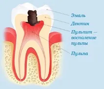 Лікування пульпіту та періодонтиту - Стоматологічна клініка - К-Денті - г пульпіту