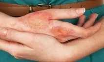 Нейродерміт симптоми та лікування у дорослих, дієта, фото лікування