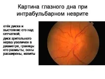 Неврит зорового нерва неврит