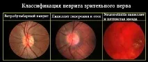 Неврит зорового нерва зорового