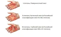 Опік руки окропом окропом