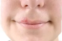 Застуда на губах (герпес першого типу), Навчися бути здоровим застуда