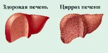 Туберкульоз та вірусні гепатити вірусні