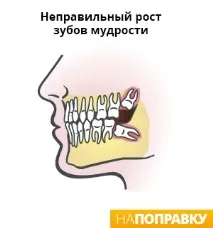 Видалення зуба мудрості наслідки, ретинований зуб. наслідки