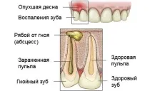 запального