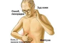 Холестатична жовтяниця симптоми, лікування симптоми