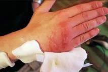 неопалима