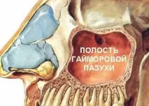 Захворювання гайморит народне лікування, Лікарські рослини лікування