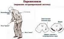 запор