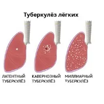 туберкульозу