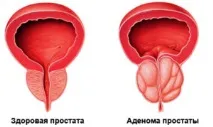 аденома