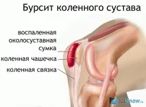 Артроз у бодібілдингу бодібілдингу