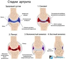 Артроз у бодібілдингу бодібілдингу