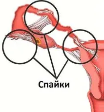 Як планувати зачаття вагітність після лапароскопії яєчника планувати