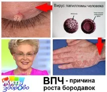 Бородавки та папіломи йдуть за 30 днів! Олена Малишева йдуть
