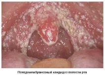 Що таке молочниця? лікування