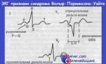 вентрикулите