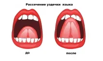 Френулопластика - що це таке, показання та протипоказання, процедура френулопластика