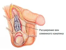 Водянка яєчка після варикоцеле може розвиватися в період від одного місяця до 2 років після