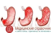 Гастродуоденіт - симптоми, дієта, лікування гастродуоденіту у дітей та дорослих лікування