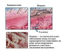 Червоні плями на ногах ступнях, з’явилися, сверблять ногах